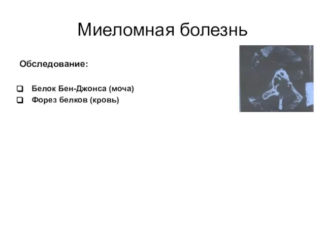 Миеломная болезнь Обследование: Белок Бен-Джонса (моча) Форез белков (кровь)