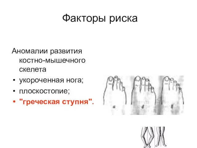 Факторы риска Аномалии развития костно-мышечного скелета укороченная нога; плоскостопие; "греческая ступня".