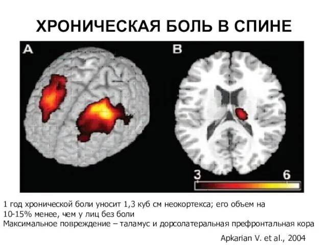 ХРОНИЧЕСКАЯ БОЛЬ В СПИНЕ Apkarian V. et al., 2004 1 год хронической