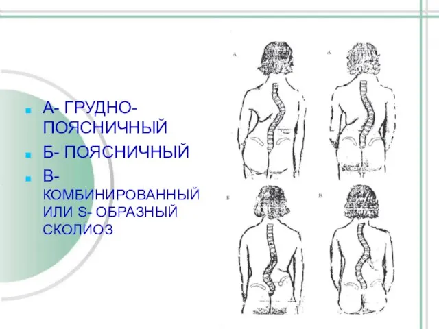 А- ГРУДНО-ПОЯСНИЧНЫЙ Б- ПОЯСНИЧНЫЙ В- КОМБИНИРОВАННЫЙ ИЛИ S- ОБРАЗНЫЙ СКОЛИОЗ