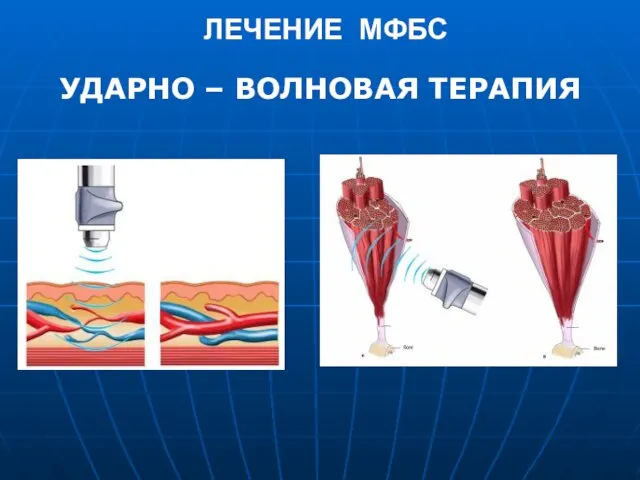 ЛЕЧЕНИЕ МФБС УДАРНО – ВОЛНОВАЯ ТЕРАПИЯ