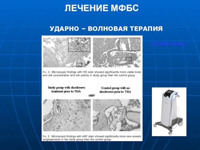 ЛЕЧЕНИЕ МФБС УДАРНО – ВОЛНОВАЯ ТЕРАПИЯ / WANG 2005 /