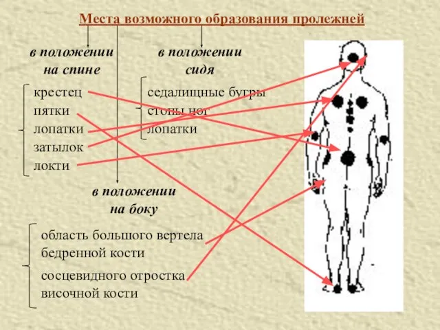 Места возможного образования пролежней в положении на спине в положении сидя в