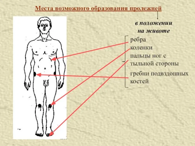 Места возможного образования пролежней в положении на животе ребра коленки пальцы ног