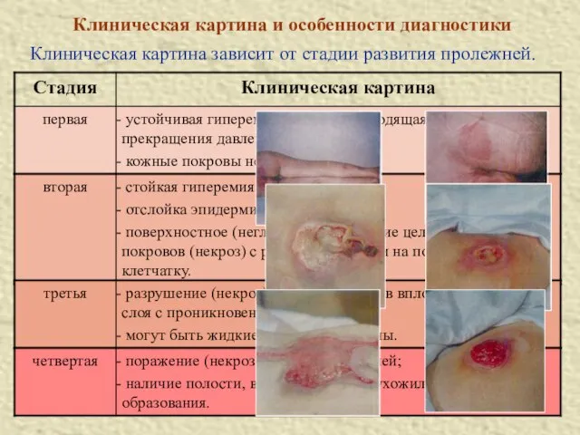 Клиническая картина и особенности диагностики Клиническая картина зависит от стадии развития пролежней.