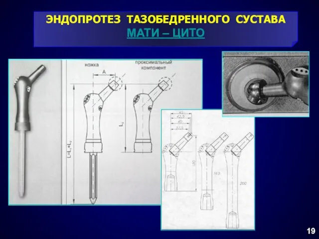 ЭНДОПРОТЕЗ ТАЗОБЕДРЕННОГО СУСТАВА МАТИ – ЦИТО 19