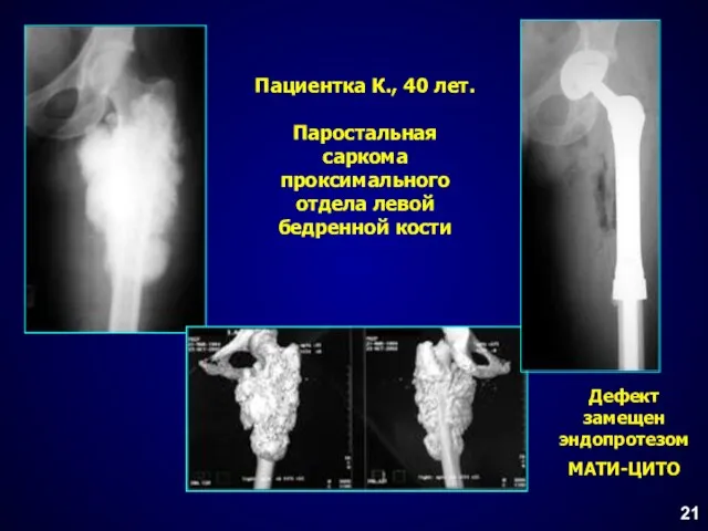 Пациентка К., 40 лет. Паростальная саркома проксимального отдела левой бедренной кости 21 Дефект замещен эндопротезом МАТИ-ЦИТО