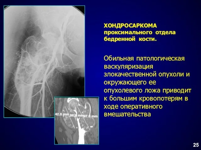 ХОНДРОСАРКОМА проксимального отдела бедренной кости. Обильная патологическая васкуляризация злокачественной опухоли и окружающего