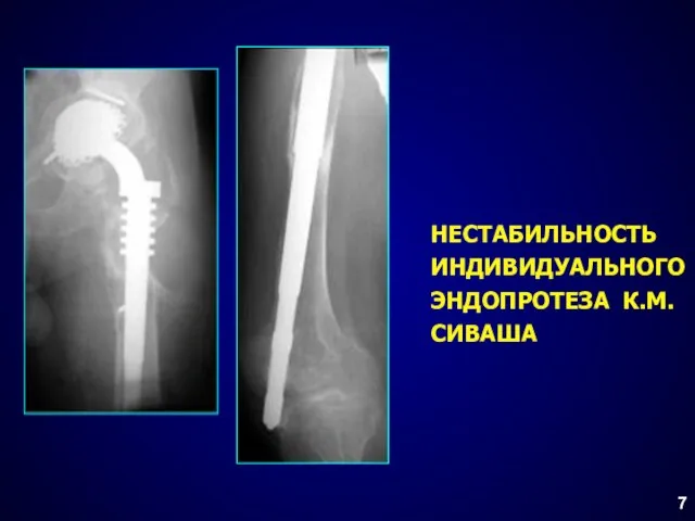 НЕСТАБИЛЬНОСТЬ ИНДИВИДУАЛЬНОГО ЭНДОПРОТЕЗА К.М.СИВАША 7