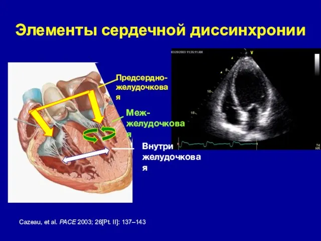 Элементы сердечной диссинхронии Предсердно-желудочковая Cazeau, et al. PACE 2003; 26[Pt. II]: 137–143 Меж- желудочковая Внутри желудочковая