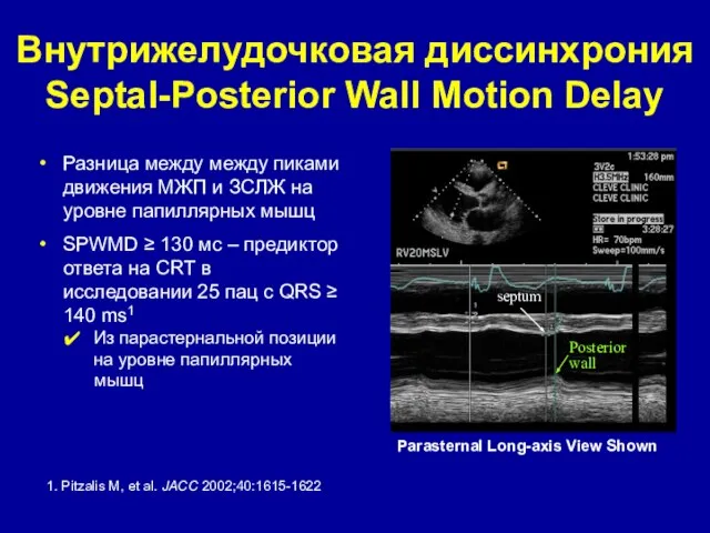 Внутрижелудочковая диссинхрония Septal-Posterior Wall Motion Delay Разница между между пиками движения МЖП
