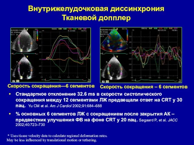 Внутрижелудочковая диссинхрония Тканевой допплер Скорость сокращения—6 сегментов Скорость сокращения – 6 сегментов