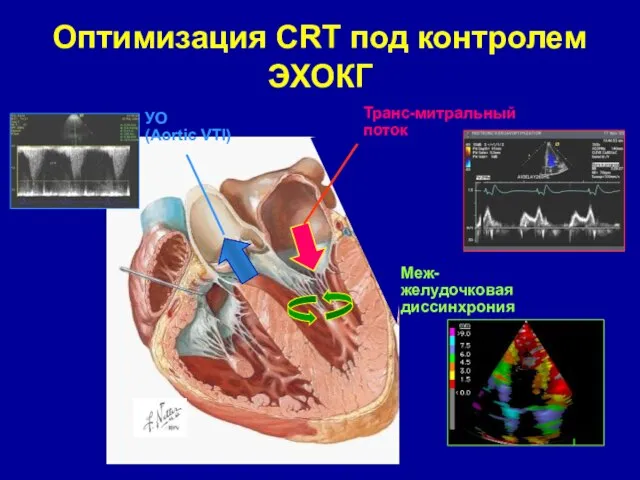 Оптимизация CRT под контролем ЭХОКГ Транс-митральный поток УО (Aortic VTI) Меж-желудочковая диссинхрония