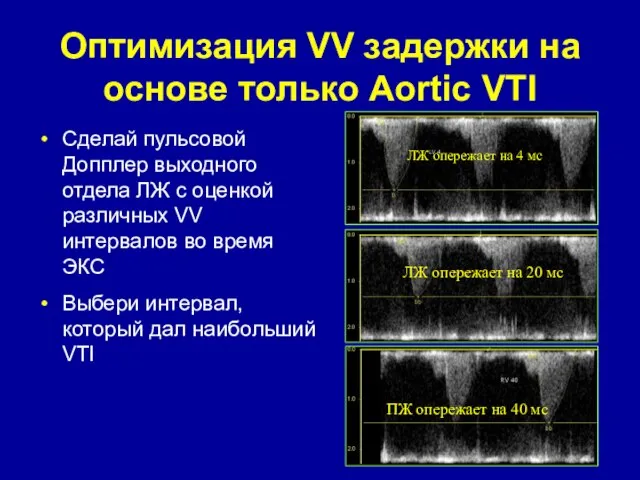Оптимизация VV задержки на основе только Aortic VTI Сделай пульсовой Допплер выходного