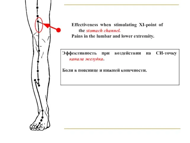 Effectiveness when stimulating XI-point of the stomach channel. Pains in the lumbar and lower extremity.