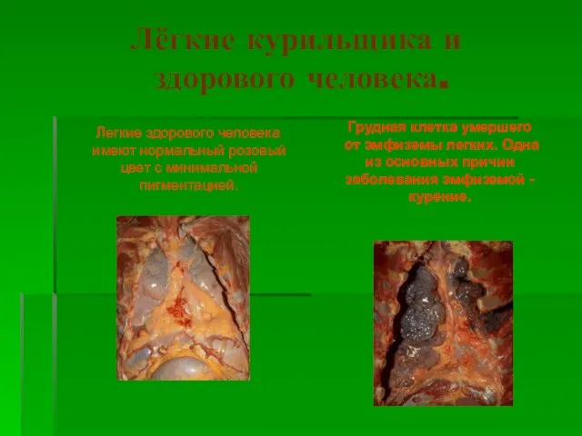 Лёгкие курильщика и здорового человека. Легкие здорового человека имеют нормальный розовый цвет