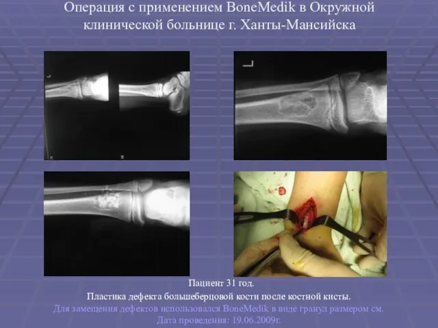 Операция с применением BoneMedik в Окружной клинической больнице г. Ханты-Мансийска Пациент 31