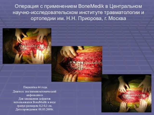 Операция с применением BoneMedik в Центральном научно-исследовательском институте травматологии и ортопедии им.
