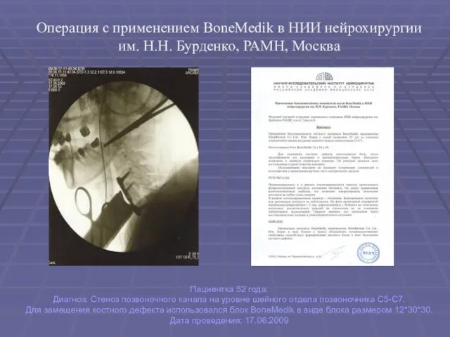 Операция с применением BoneMedik в НИИ нейрохирургии им. Н.Н. Бурденко, РАМН, Москва