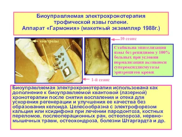 Биоуправляемая электрохронотерапия трофической язвы голени. Аппарат «Гармония» (макетный экземпляр 1988г.) Биоуправляемая электрохронотерапия