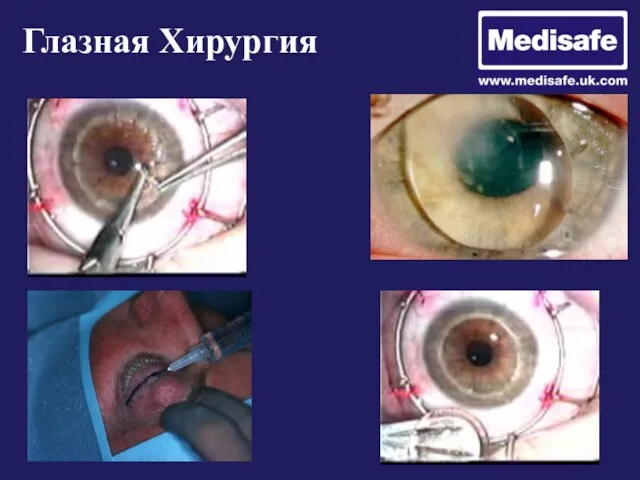 Глазная Хирургия