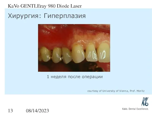 08/14/2023 KaVo GENTLEray 980 Diode Laser Хирургия: Гиперплазия 1 неделя после операции