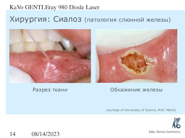 08/14/2023 KaVo GENTLEray 980 Diode Laser Хирургия: Сиалоз (патология слюнной железы) Разрез