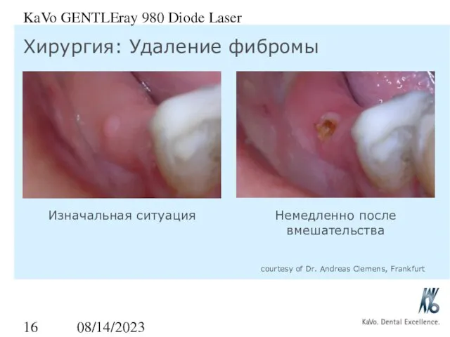 08/14/2023 KaVo GENTLEray 980 Diode Laser Хирургия: Удаление фибромы Изначальная ситуация Немедленно