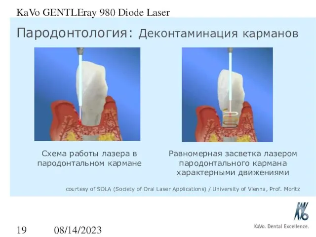 08/14/2023 KaVo GENTLEray 980 Diode Laser Схема работы лазера в пародонтальном кармане