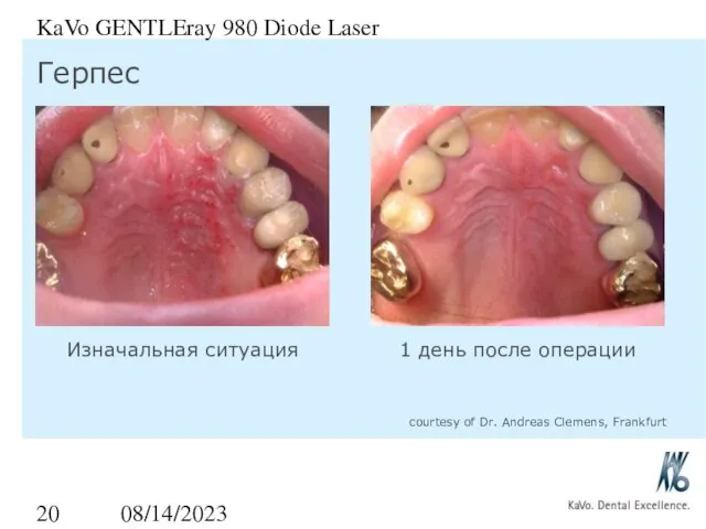 08/14/2023 KaVo GENTLEray 980 Diode Laser Герпес Изначальная ситуация 1 день после