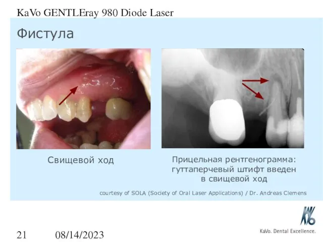 08/14/2023 KaVo GENTLEray 980 Diode Laser Фистула Свищевой ход Прицельная рентгенограмма: гуттаперчевый