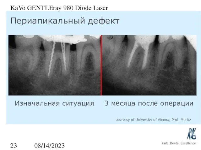 08/14/2023 KaVo GENTLEray 980 Diode Laser Периапикальный дефект Изначальная ситуация 3 месяца