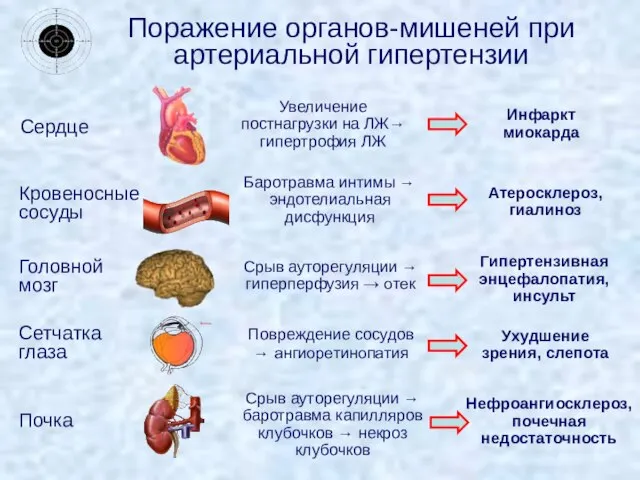 Поражение органов-мишеней при артериальной гипертензии Сердце Увеличение постнагрузки на ЛЖ→ гипертрофия ЛЖ