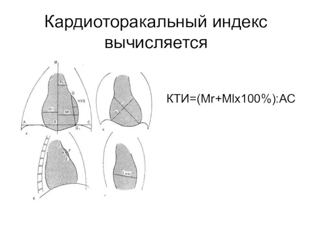 Кардиоторакальный индекс вычисляется КТИ=(Mr+Mlх100%):АС