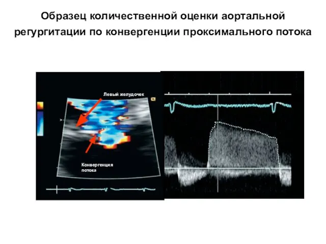 Образец количественной оценки аортальной регургитации по конвергенции проксимального потока Конвергенция потока Левый желудочек