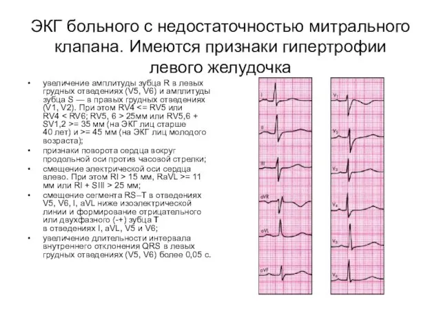 ЭКГ больного с недостаточностью митрального клапана. Имеются признаки гипертрофии левого желудочка увеличение