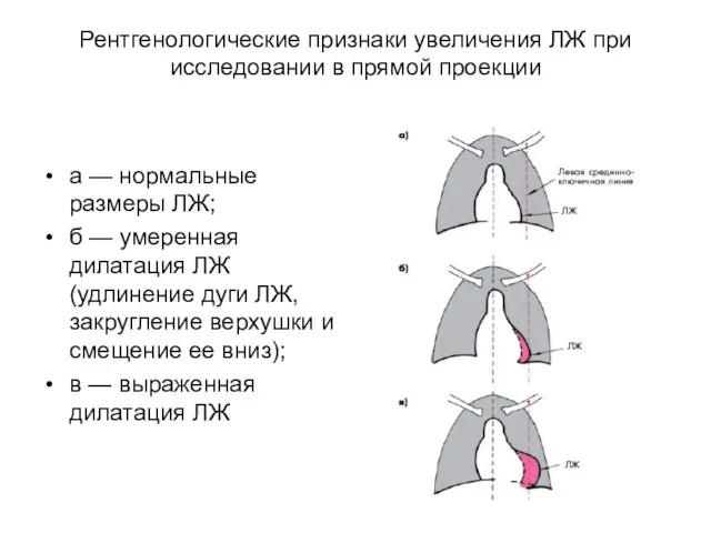 Рентгенологические признаки увеличения ЛЖ при исследовании в прямой проекции а — нормальные