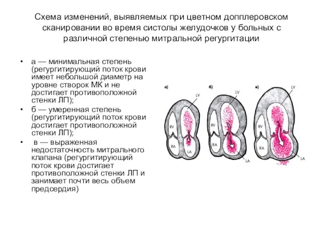 Схема изменений, выявляемых при цветном допплеровском сканировании во время систолы желудочков у