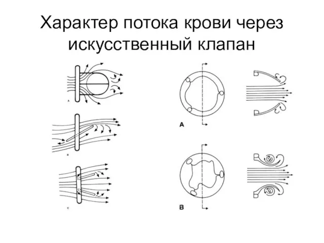 Характер потока крови через искусственный клапан