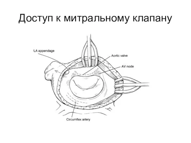 Доступ к митральному клапану