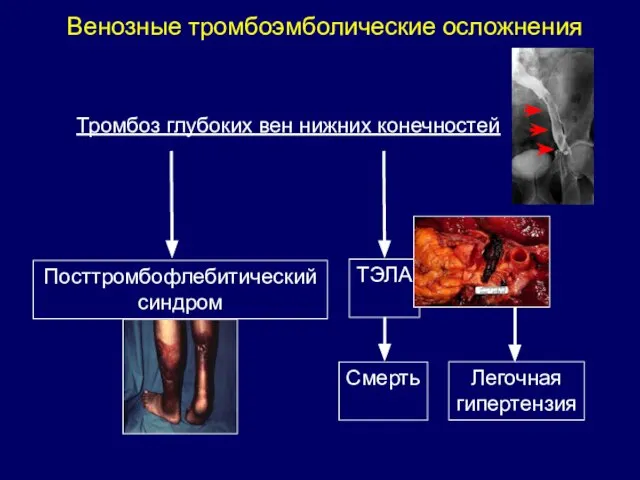 Венозные тромбоэмболические осложнения Тромбоз глубоких вен нижних конечностей Посттромбофлебитический синдром ТЭЛА Смерть Легочная гипертензия