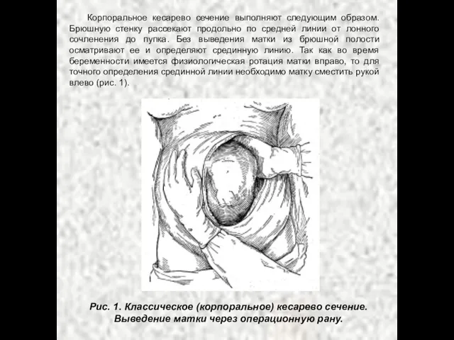 Корпоральное кесарево сечение выполняют следующим образом. Брюшную стенку рассекают продольно по средней