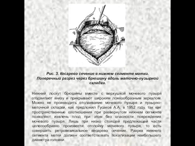 Рис. 3. Кесарево сечение в нижнем сегменте матки. Поперечный разрез через брюшину