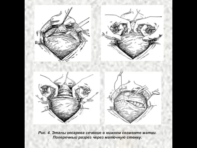 Рис. 4. Этапы кесарева сечение в нижнем сегменте матки. Поперечный разрез через маточную стенку.