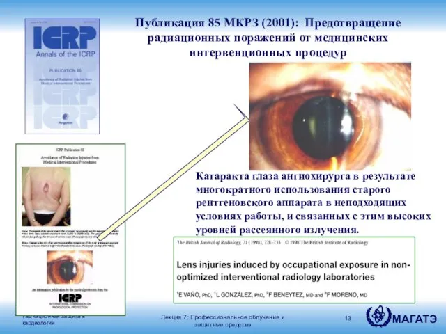 Катаракта глаза ангиохирурга в результате многократного использования старого рентгеновского аппарата в неподходящих