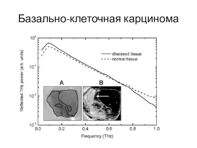 Базально-клеточная карцинома