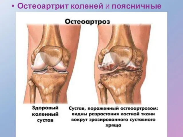 Остеоартрит коленей и поясничные боли.