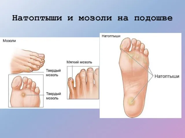 Натоптыши и мозоли на подошве