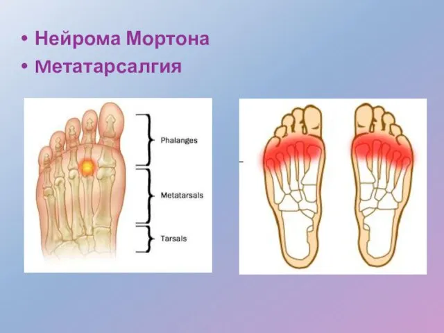 Нейрома Мортона Mетатарсалгия