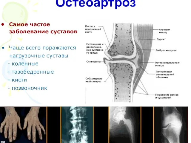 Остеоартроз Самое частое заболевание суставов Чаще всего поражаются нагрузочные суставы - коленные